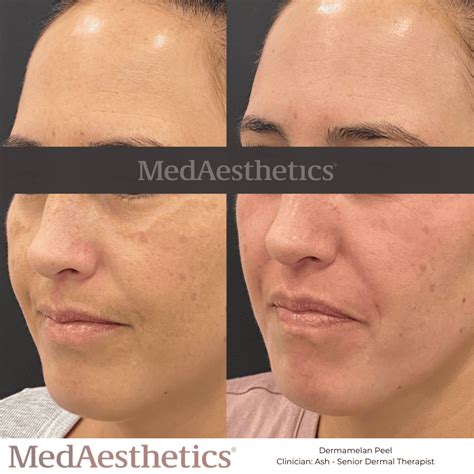 belkyra perth|MedAesthetics .